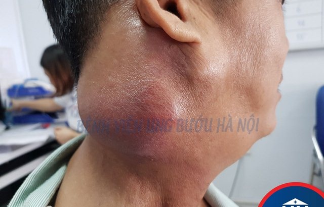 Đắp thuốc nam chữa ung thư họng ảnh 1 Dap thuoc nam chua ung thu hong anh 1