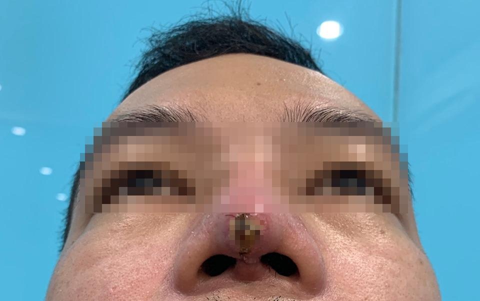 suýt mất mũi vì thẩm mỹ tại spa ảnh 1 suyt mat mui vi tham my tai spa anh 1