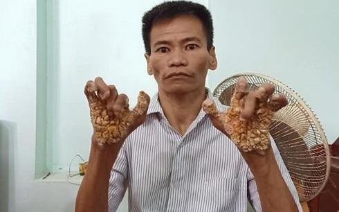 Nguoi dan ong mac benh 'nguoi cay' tai Ninh Binh hinh anh