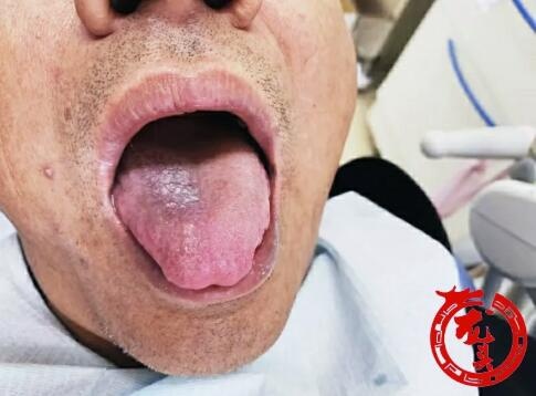 biến chứng ung thư vì hút thuốc ảnh 1 bien chung ung thu vi hut thuoc anh 1