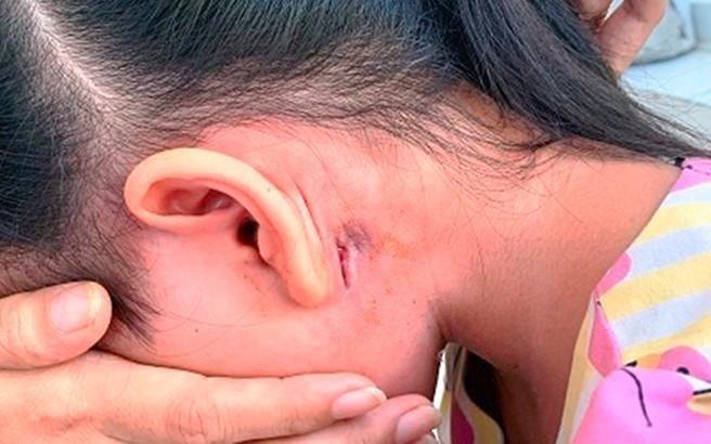 Benh Whitmore lay nhiem nhu the nao? hinh anh