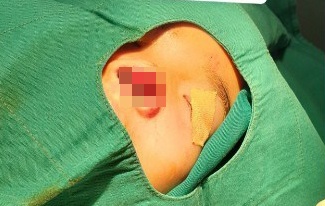 Lục thùng rác tìm mảnh cánh mũi bị đứt rời  ảnh 1 Luc thung rac tim manh canh mui bi dut roi anh 1
