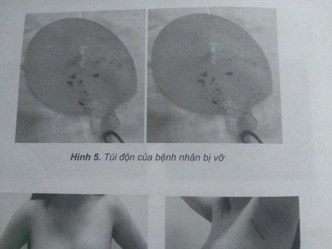 Vo tui don nguc anh 1