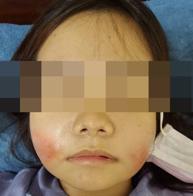 bien chung vi tiem filler anh 1