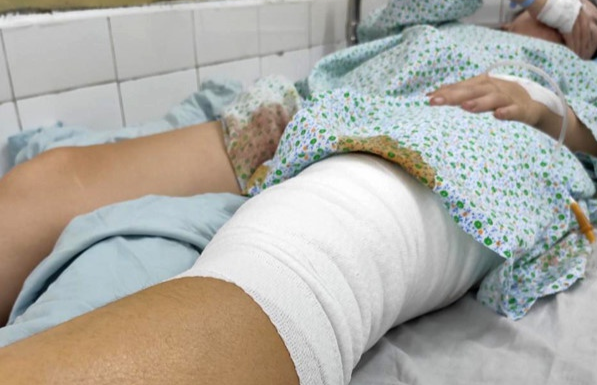 Nhap khau da nguoi de dieu tri cho nan nhan bong hinh anh