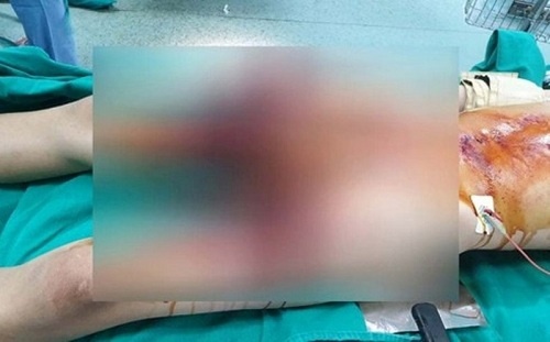 Dap nat ban tay vi che phao anh 1