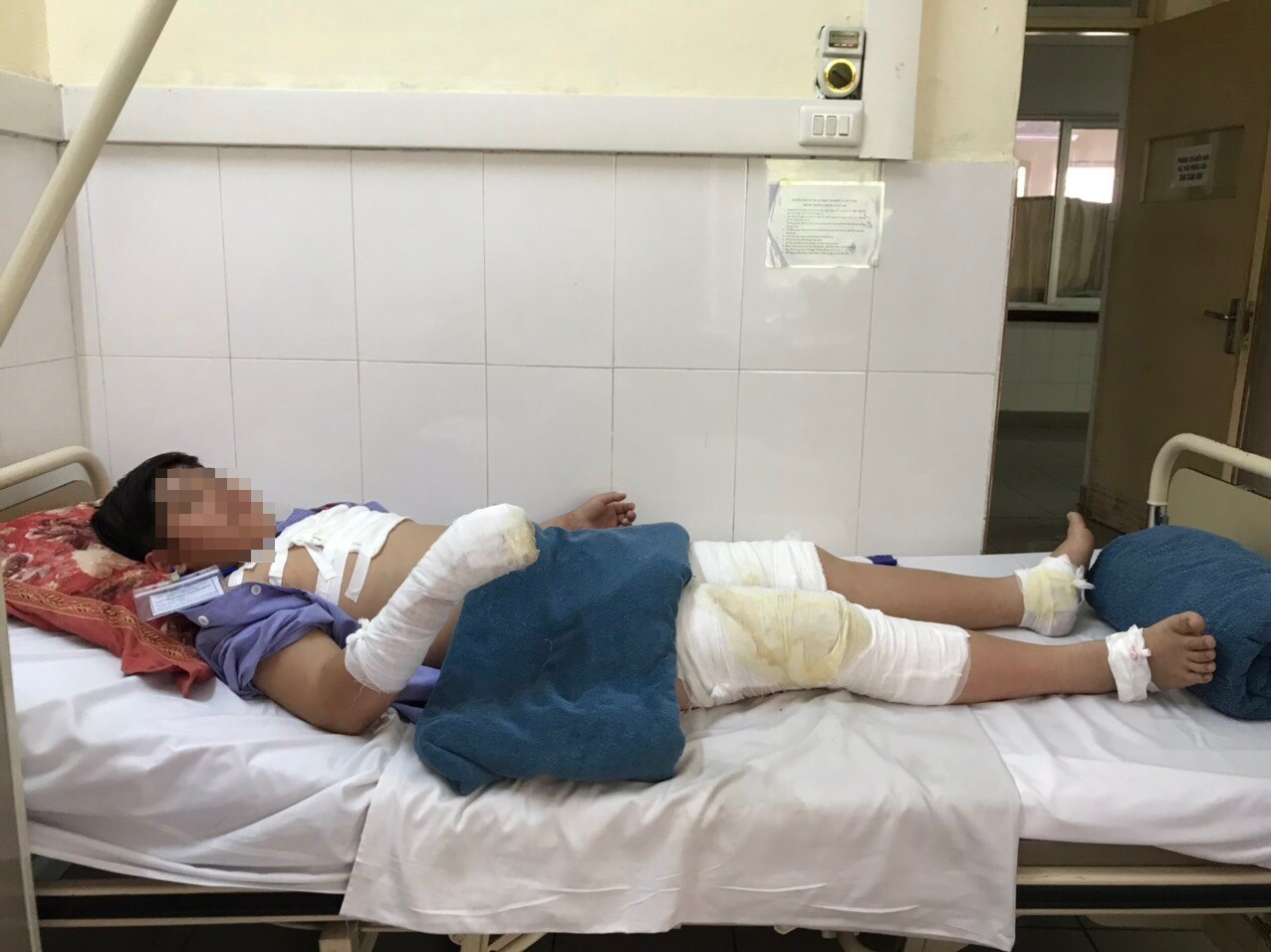 bong nang nhieu vung co the vi nghich con anh 1