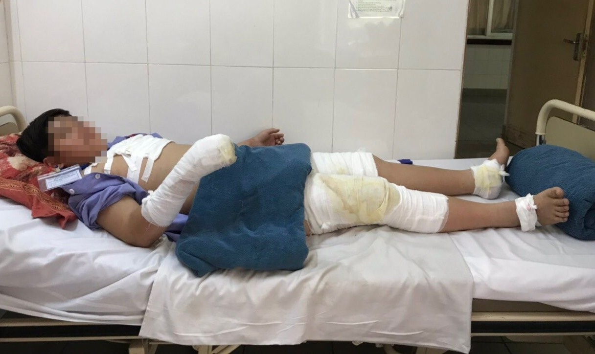 Be trai 11 tuoi bong nang nhieu vung co the vi nghich con hinh anh