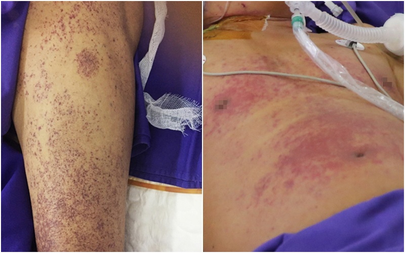 nguy kich do nhiem lien cau khuan lon anh 1