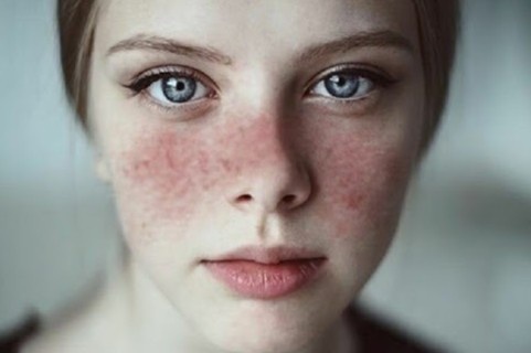 Benh lupus ban do nguy hiem the nao? hinh anh