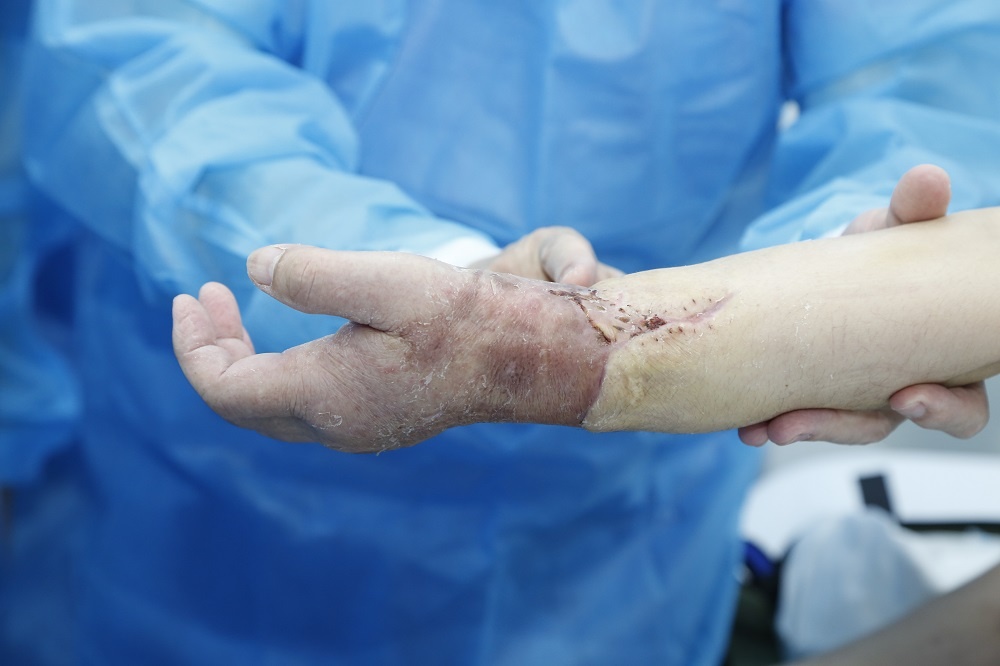 Ghep tay tu nguoi cho song dau tien tren the gioi anh 5