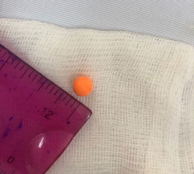 Hạt mắc kẹt trong mũi ảnh 1 Hat mac ket trong mui anh 1