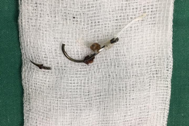 moc cau ca xuyen qua mi mat anh 1