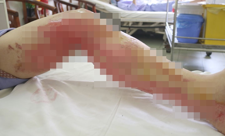 Bỏng nặng vì nướng mực bằng cồn ảnh 1 Bong nang vi nuong muc bang con anh 1