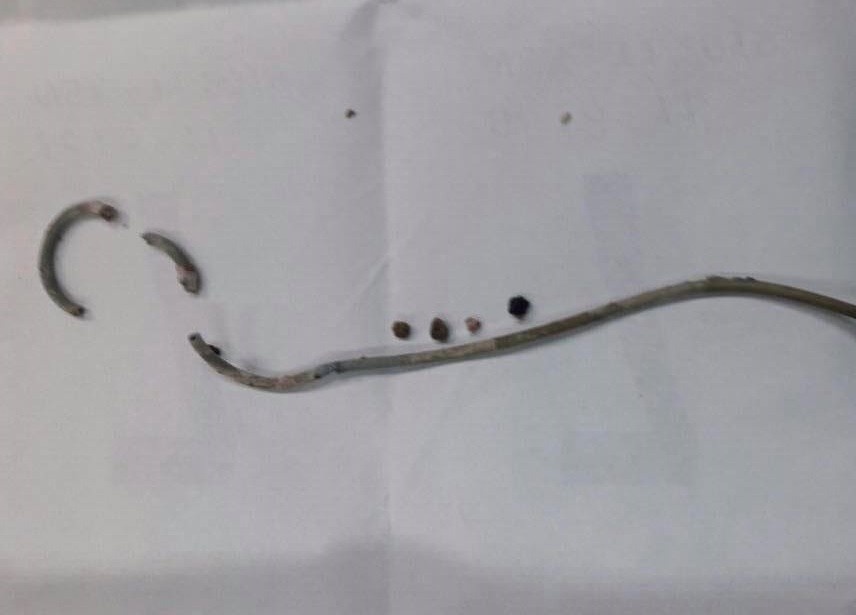 Quen ong thong trong nguoi suot 3 nam hinh anh