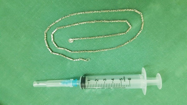 Gap di vat duong tieu hoa anh 1