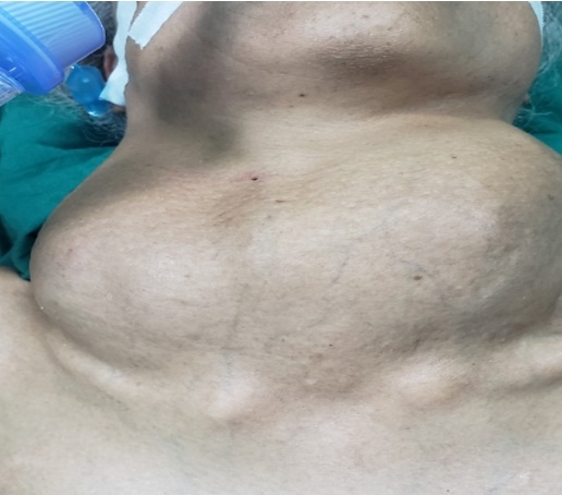 Phau thuat khoi u buou giap khong lo anh 1