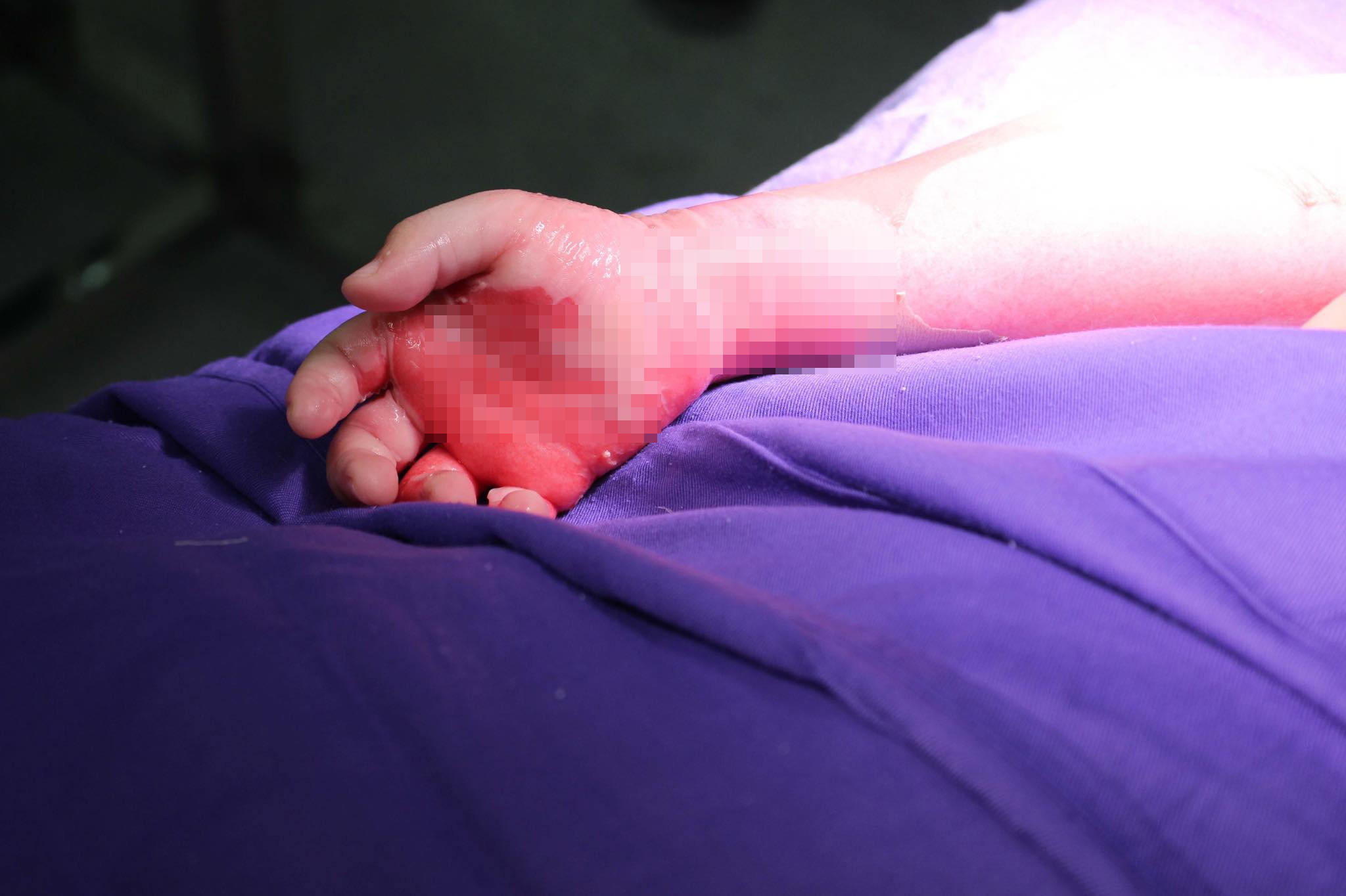 Bỏng nặng vì ngã vào nước nóng ảnh 1 Bong nang vi nga vao nuoc nong anh 1