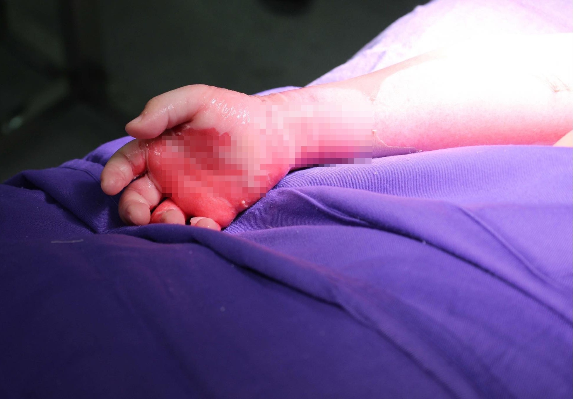 Nga vao chau nuoc nong, be 3 tuoi bong nang hinh anh