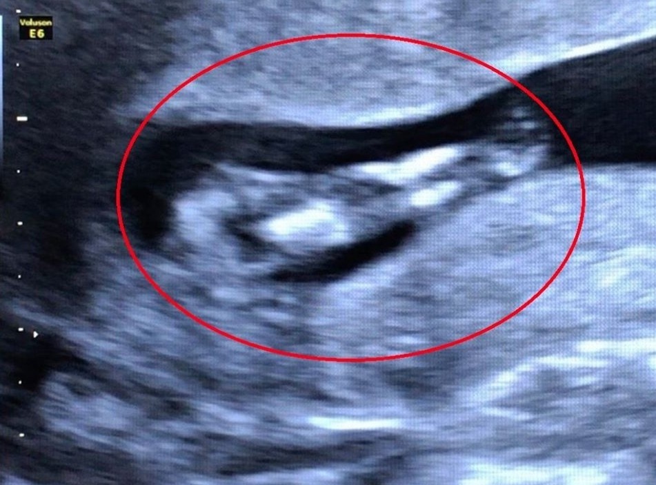 Thai nhi mac hoi chung nguoi ca hiem gap hinh anh