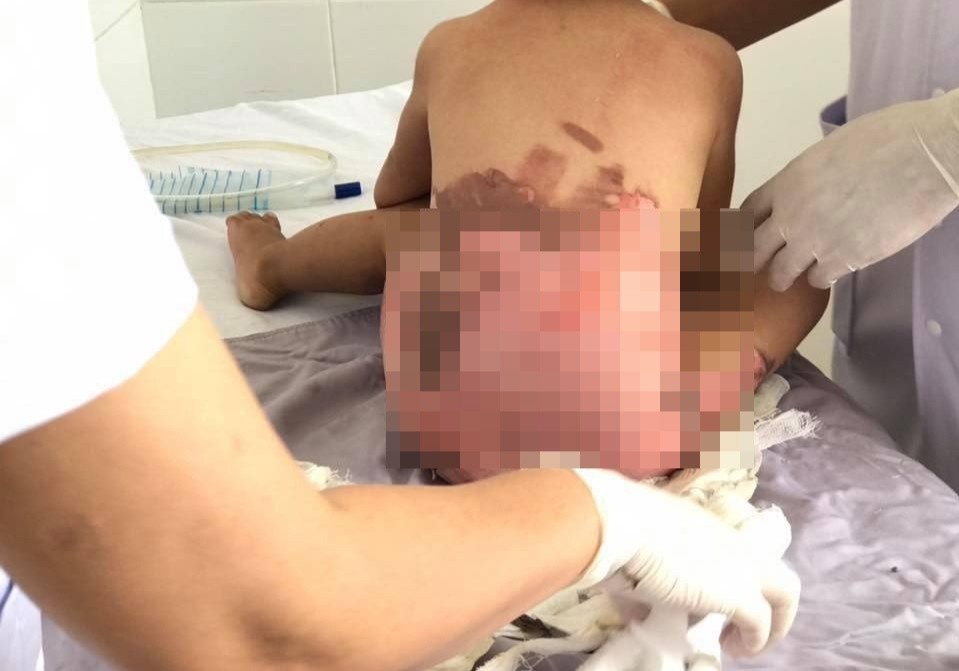 Benh nhi bong nang vi nga vao chau nuoc soi hinh anh