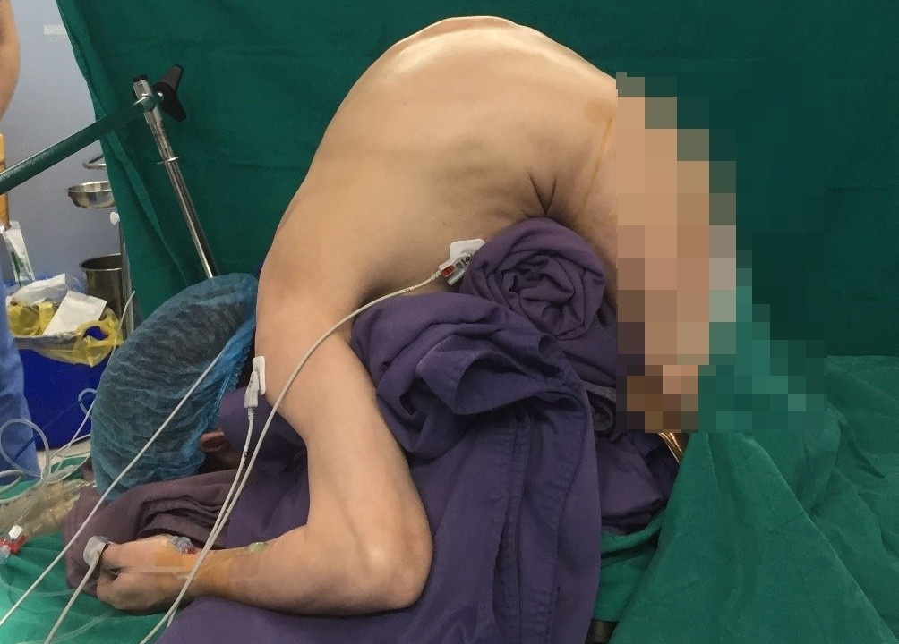 Nguoi dan ong cao them 34 cm sau phau thuat nan chinh cot song hinh anh