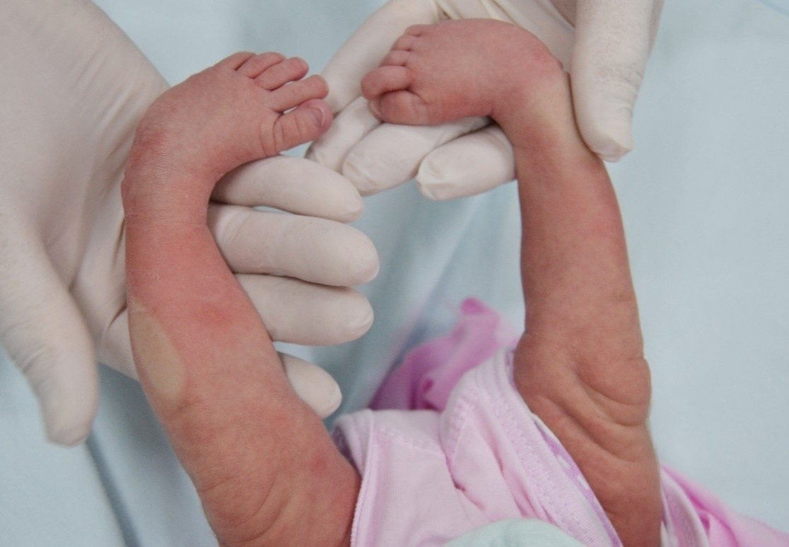 Chua ban chan khoeo bam sinh cho be 3 ngay tuoi hinh anh