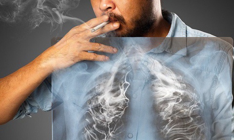 dau hieu ung thu phoi anh 2