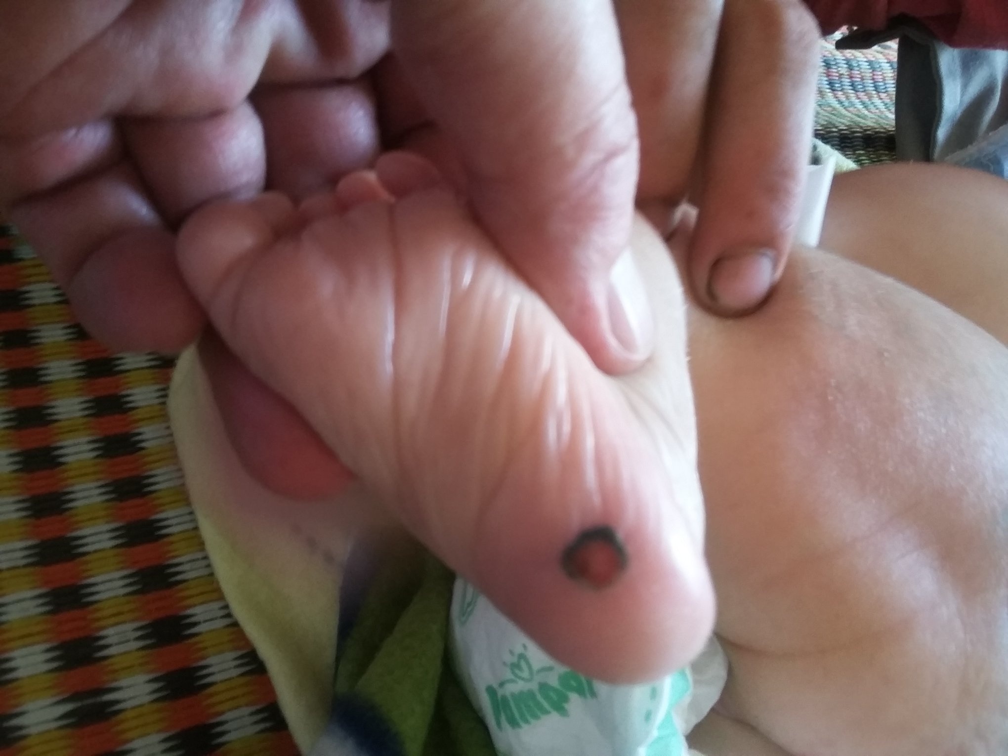 Be 1 thang tuoi mac benh giang mai anh 1