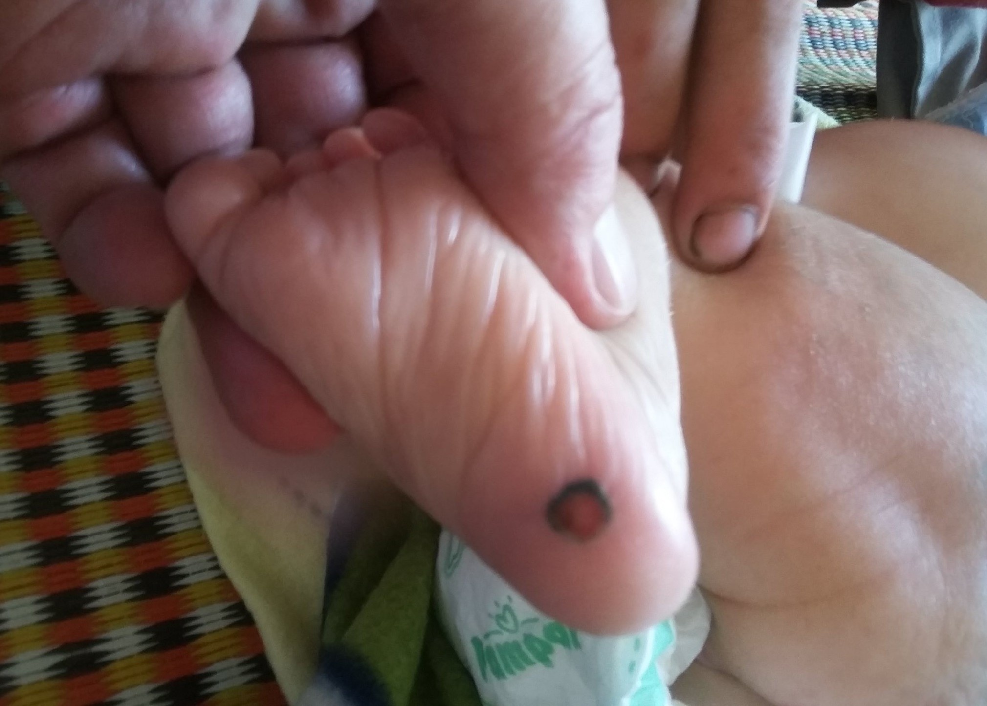 Be mot thang tuoi mac benh giang mai hinh anh