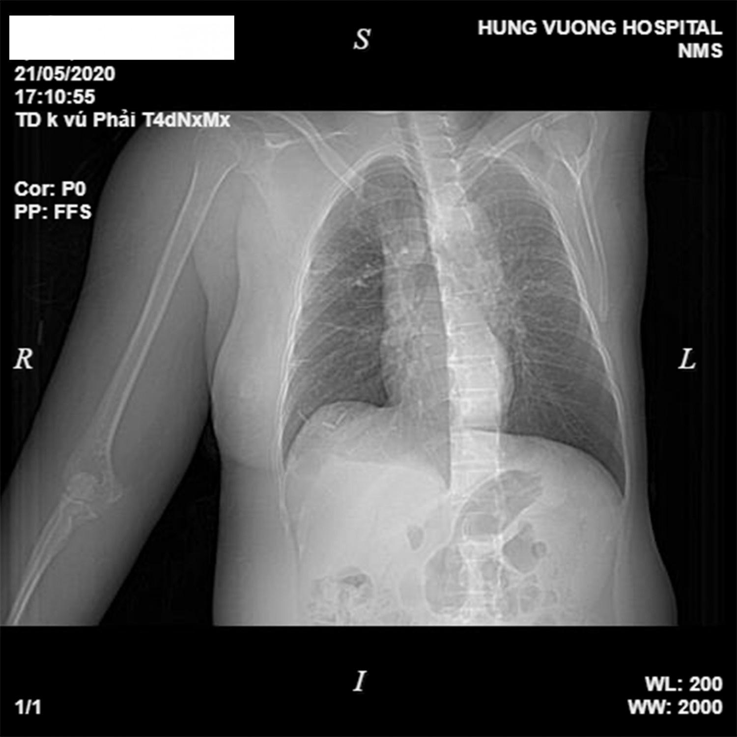 ung thư vú di căn ảnh 1 ung thu vu di can anh 1