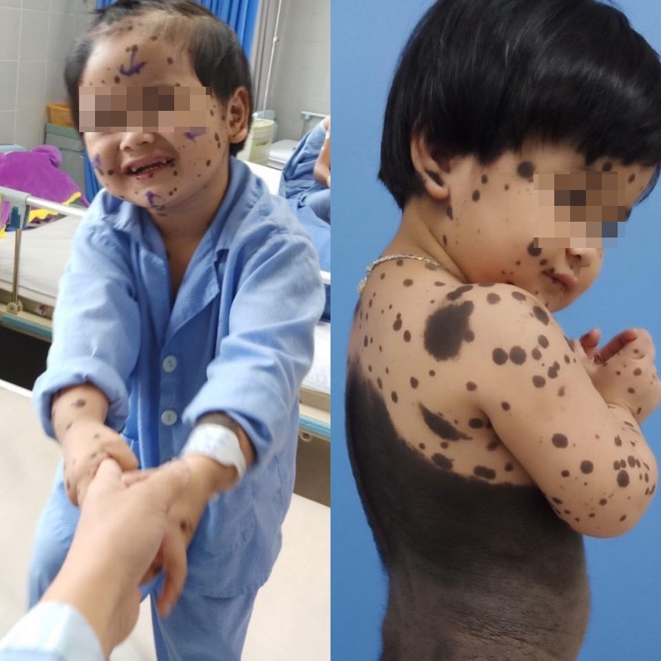 Be bi cham den khap co the anh 1