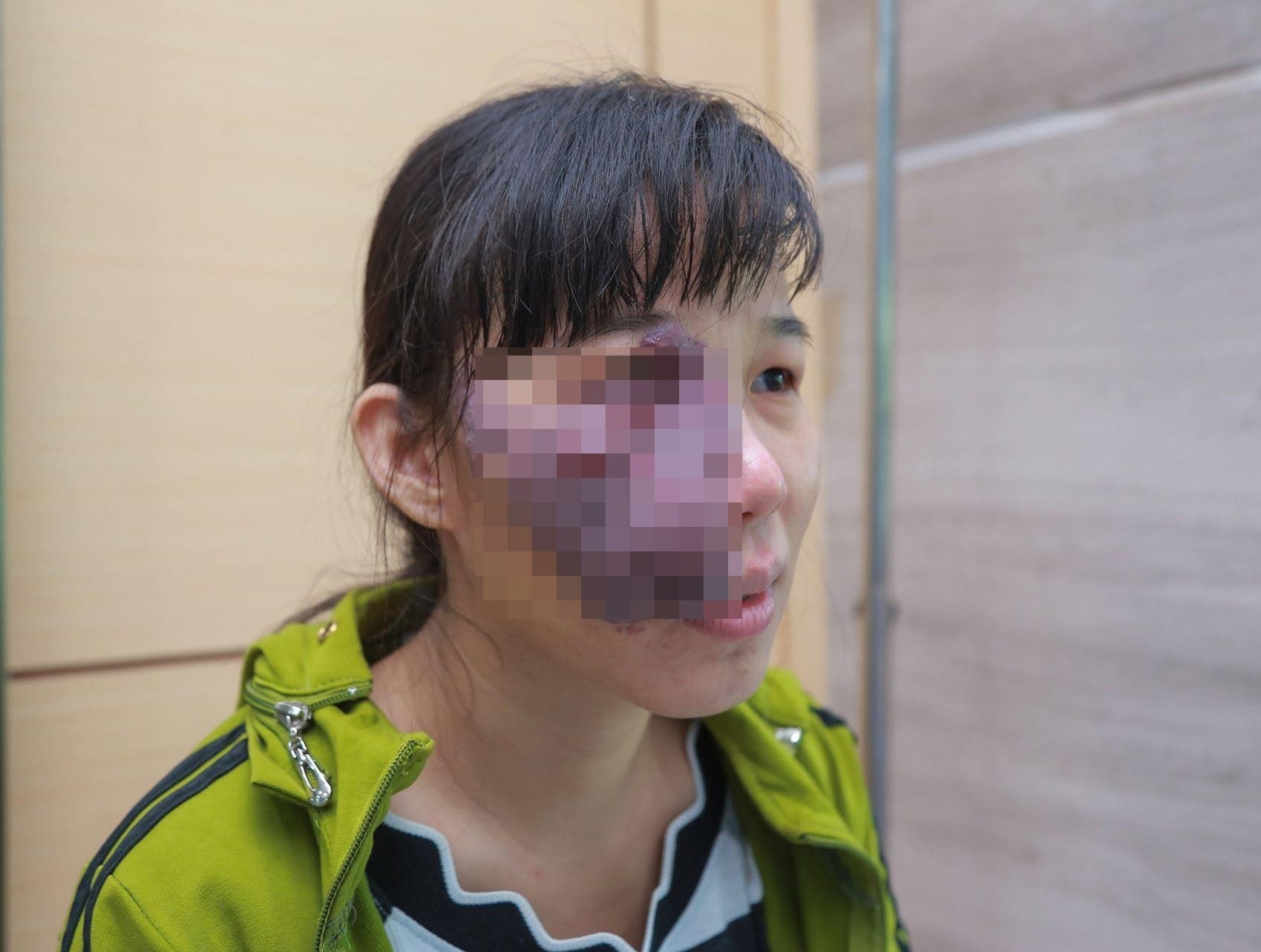 Mang 5 trieu dong di thuc hien giac mo 'co khuon mat binh thuong' hinh anh