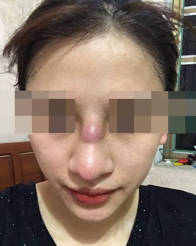 thẩm mỹ nâng mũi ảnh 1 tham my nang mui anh 1