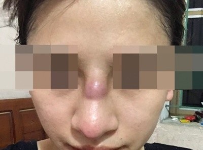 Co gai 19 tuoi nhiem trung mui sau khi lam dep o spa hinh anh