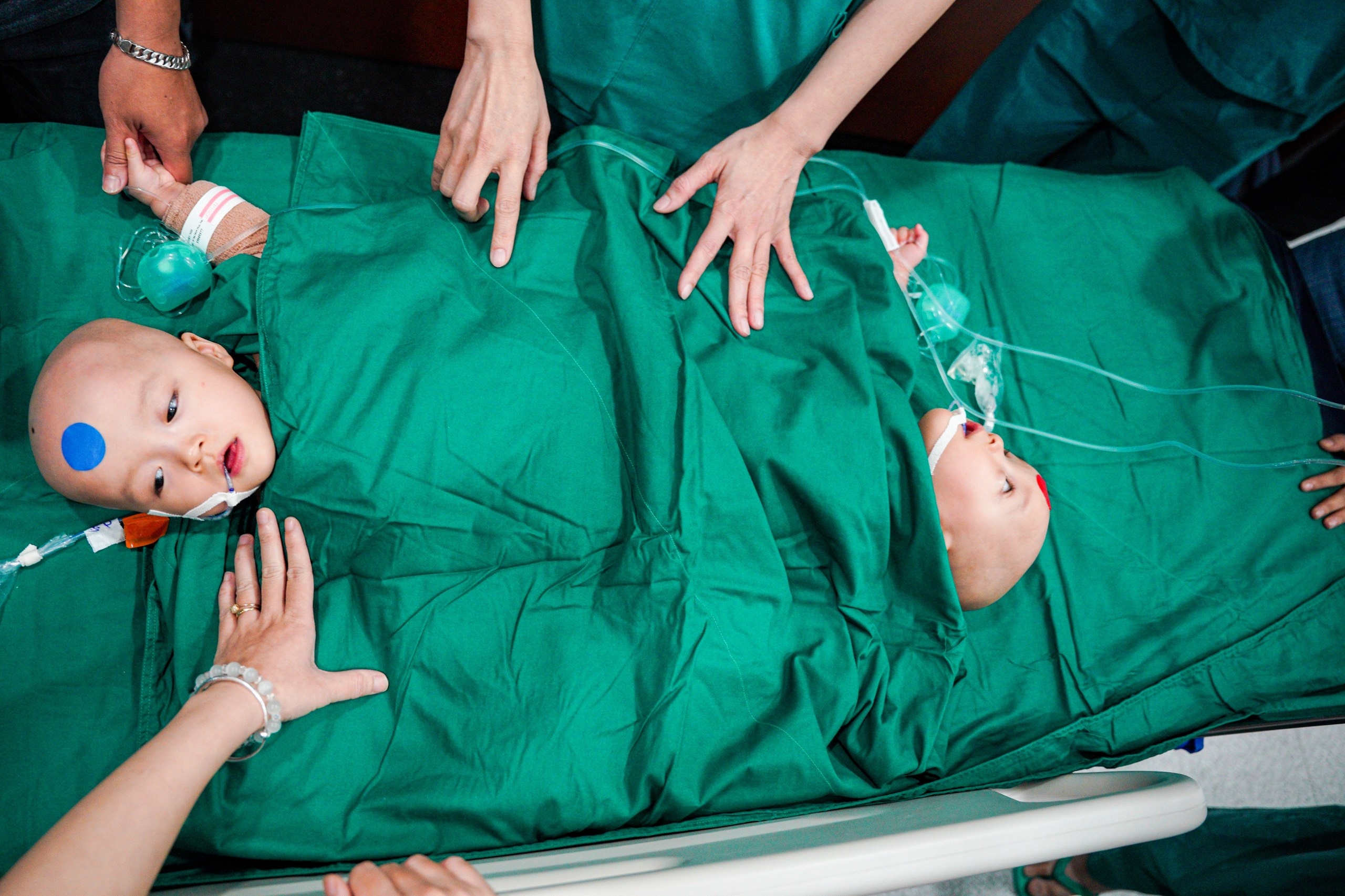 Tach cap song sinh dinh lien anh 4