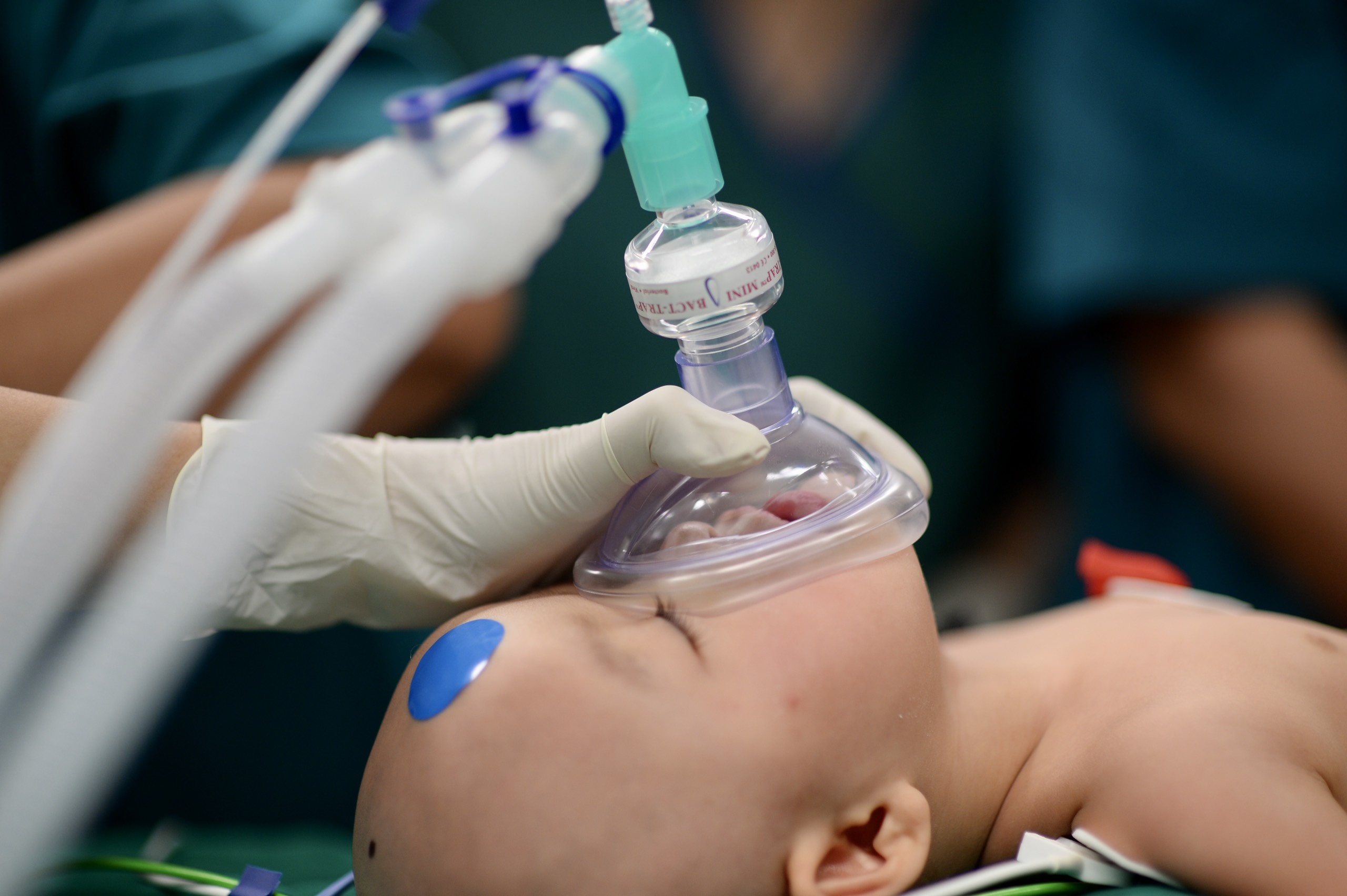 Tach cap song sinh dinh lien anh 7