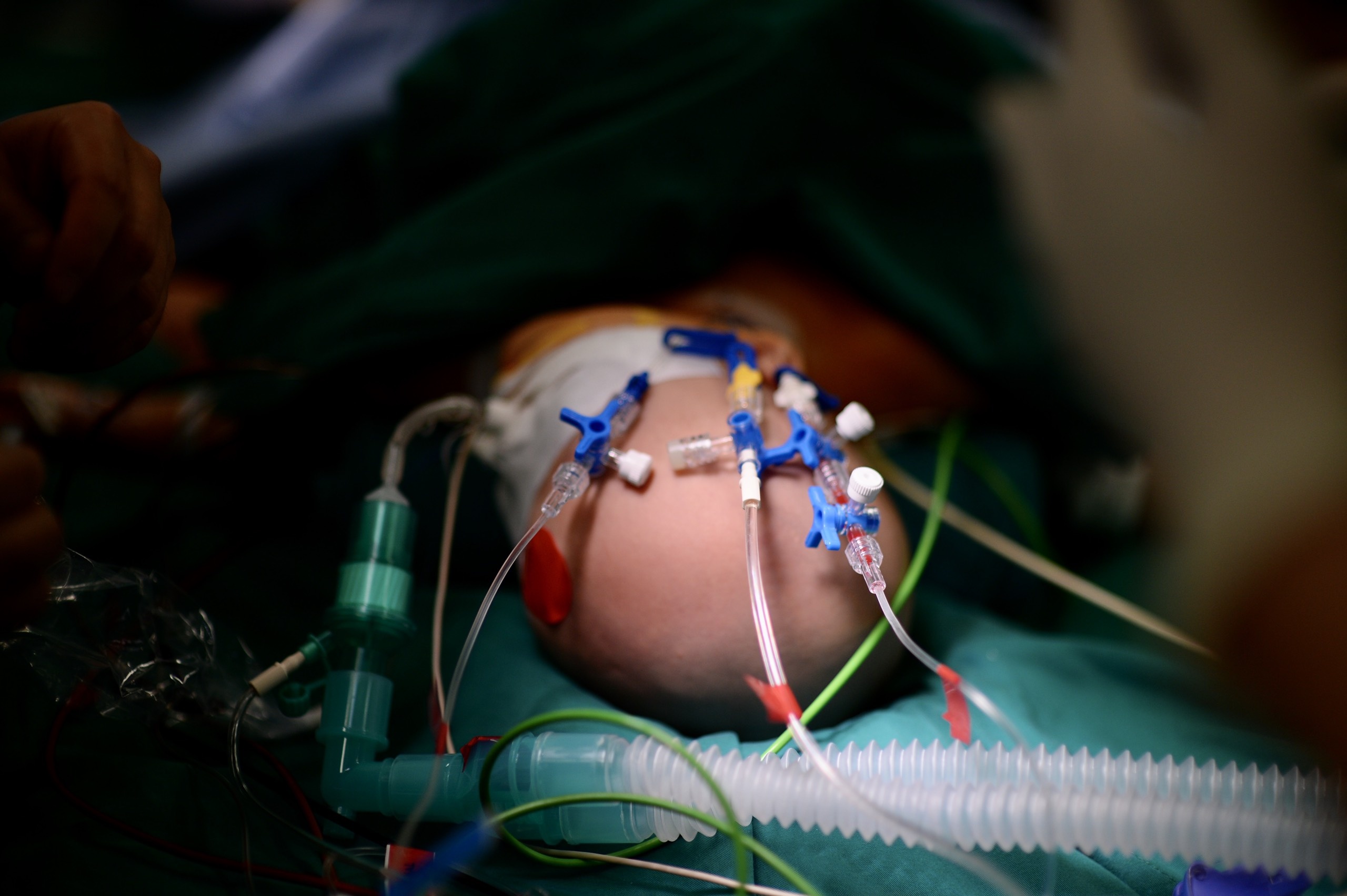 Tach cap song sinh dinh lien anh 9