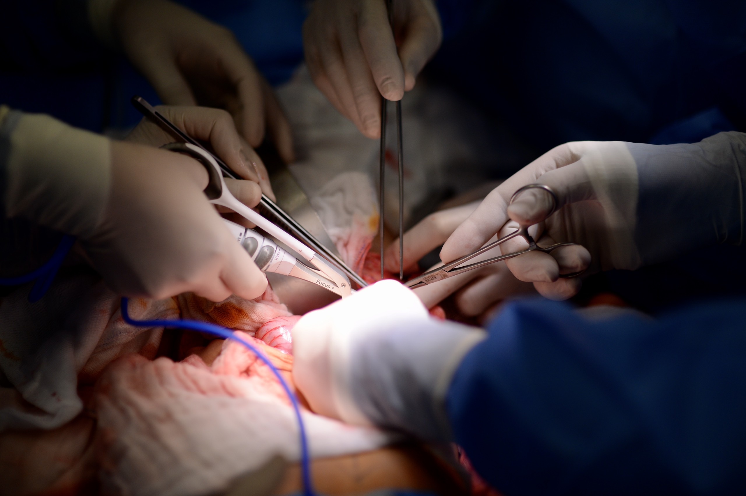 Tach cap song sinh dinh lien anh 5