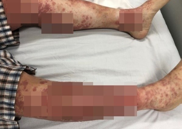 Sot cao, mun mu khap chan vi tu chua benh tai nha hinh anh