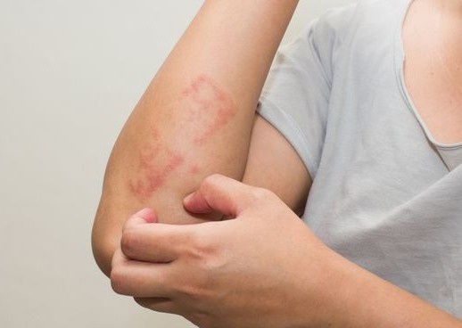 Dau hieu tren da cua benh nhan Covid-19 hinh anh