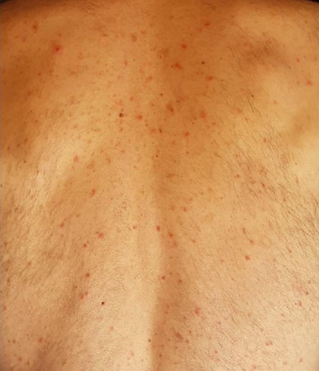 Dau hieu tren da cua Covid-19 anh 1