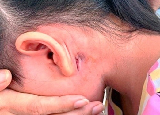 Nu sinh o Dak Lak mac benh Whitmore anh 1