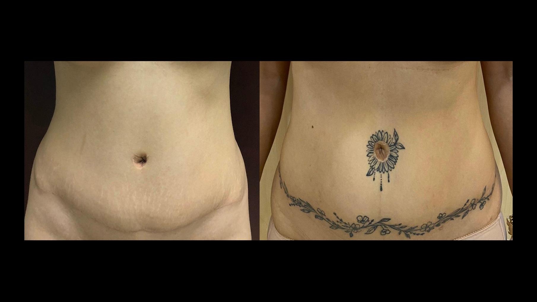 tạo hình thành bụng ảnh 23 tao hinh thanh bung anh 23