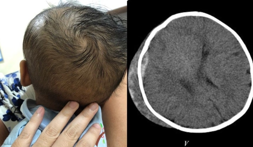 Tụ máu ngoài màng cứng vì tập đi ảnh 1 Tu mau ngoai mang cung vi tap di anh 1