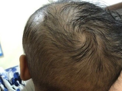 Be 6 thang tuoi bi tu mau nao vi nga khi tap di hinh anh