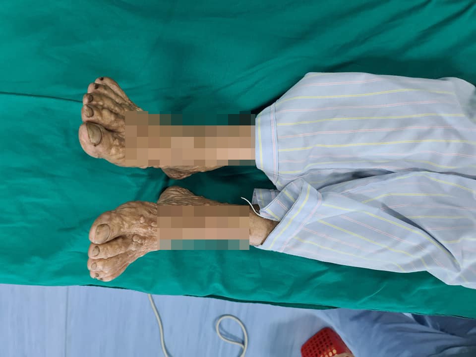 Hàng nghìn khối u khắp cơ thể ảnh 1 Hang nghin khoi u khap co the anh 1