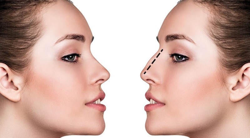 Nhung dieu can biet khi nang mui anh 6