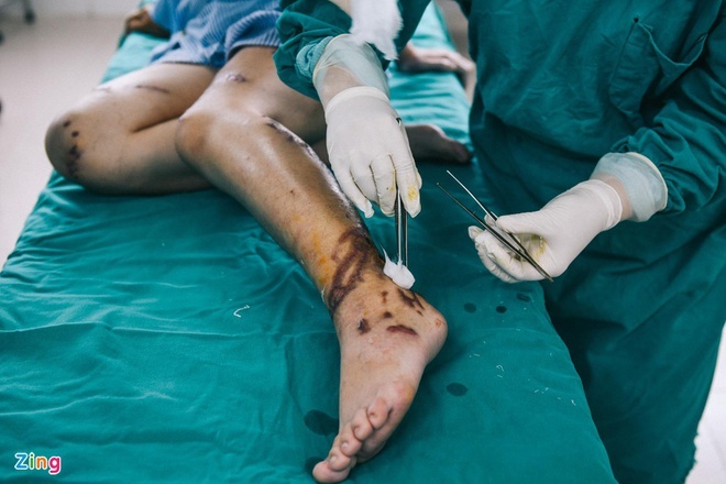 Người phụ nữ bị chồng tẩm xăng đốt ảnh 1 Nguoi phu nu bi chong tam xang dot anh 1