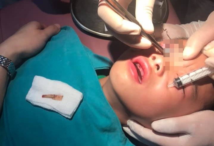 Be trai 6 tuoi bi manh go dam vao mat hinh anh